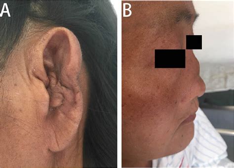 Clinical Presentation Cauliflower Like Auricle A And Saddle Nose B