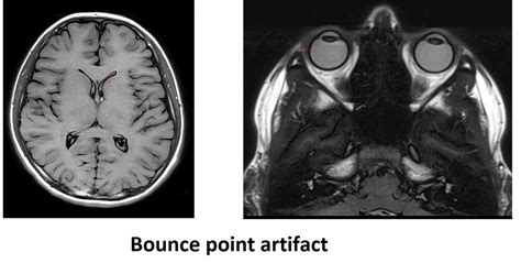 Bounce Point Artifact Mri