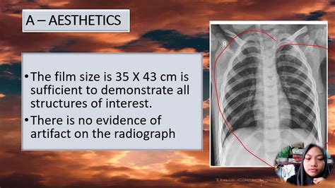 Radiographic Image Evaluation Of Ap Andoblique Ribs Youtube