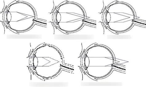 5 Classes of Astigmatism Diagram | Quizlet