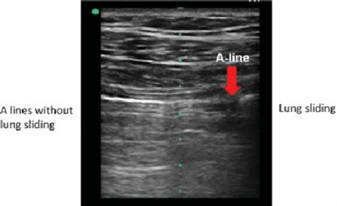 Sliding Lung Sign Ultrasound