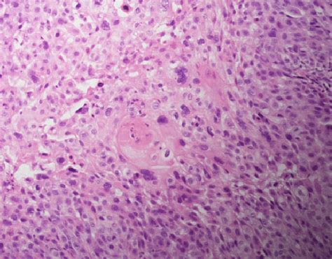 Hematoxylin And Eosin Staining Shows Squamous Cell Cancer Download Scientific Diagram