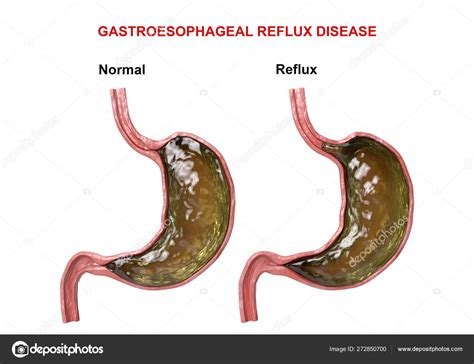 Reflux Gastro Sophagien D Faillance Du M Canisme Digestif Sphincter