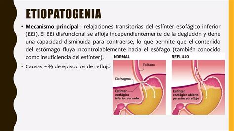 Reflujo Gastroesofágico Ppt