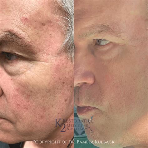 Before And After Combination Therapy Gallery K2 Medicine