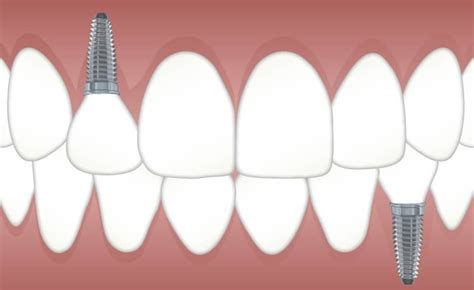 Implantes Dentales En Madrid C Mo Elegir La Mejor Cl Nica De Implantes