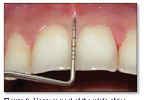 Surgical Reconstruction Of Interdental Papilla Using Subepithelial