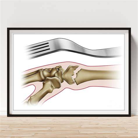  broken wrist