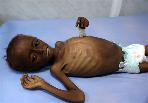 سوء التغذية بسبب نقص الحديد: المشكلة الصامتة التي تواجه ملايين الأشخاص حول العالم