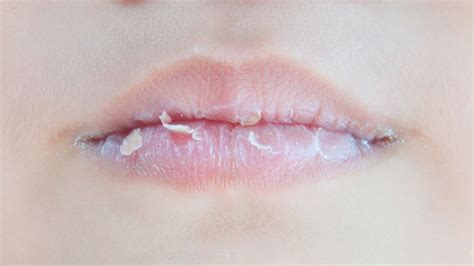  Bibir Seindah Es: Rahasia Mengatasi Bibir Pecah-Pecah dan Gelap 