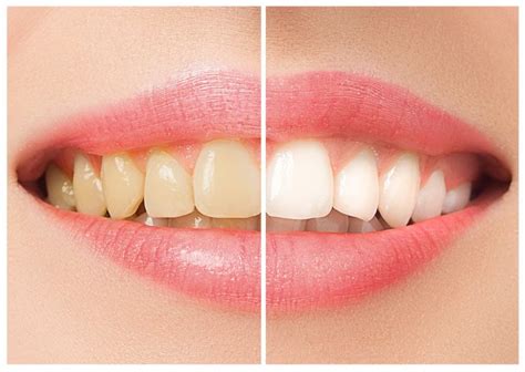 Bleka tänder naturligt: En steg-för-steg-guide till ett strålande leende
