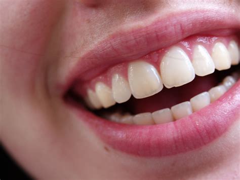  Tandblekning zoom: Få ett strålande vitt leende idag! 
