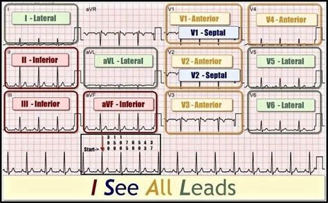12 Lead Stemi Chart