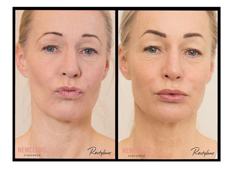 Botox Läppar: Före och Efter