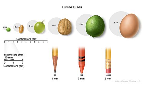 Brain Tumor Size Chart