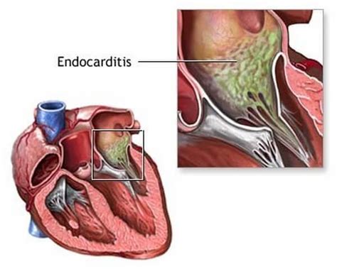 Cuscinetti Endocardici: The Unsung Heroes of Your Heart