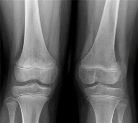 Discover the World of Knee X-rays: Weight-Bearing Perspectives