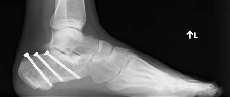 Embarking on the Path to Recovery: A Journey of Weight-bearing After Calcaneus Fracture