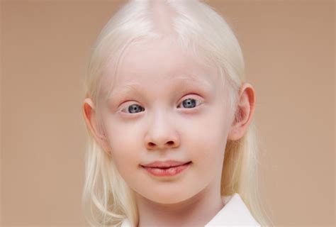 Escarcha picante albinismo: una guía para entender este trastorno poco común