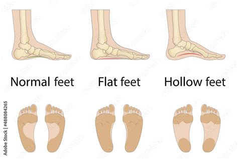 Foot Deformities Chart