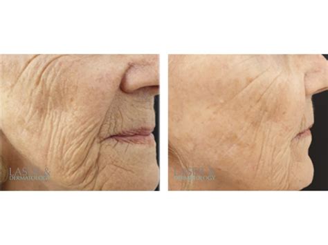 Fotona 4D före efter: Upplev en förnyad hud med banbrytande laserbehandling