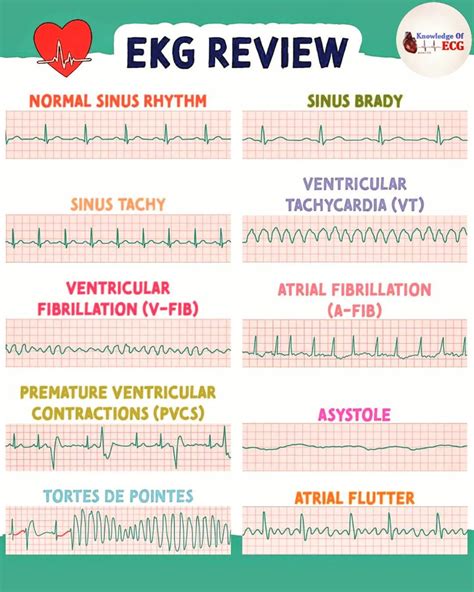 Free Printable Ekg Interpretation Cheat Sheet