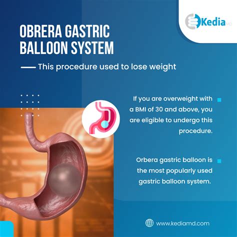 Gastric Balloon Gratis: Your Path to a Healthier Lifestyle