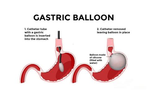 Gastric Balloon Landstinget: Empowering Healthier Lifestyles