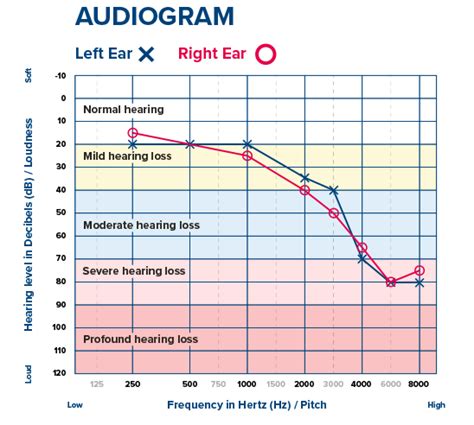 Hearing Loss Levels Chart