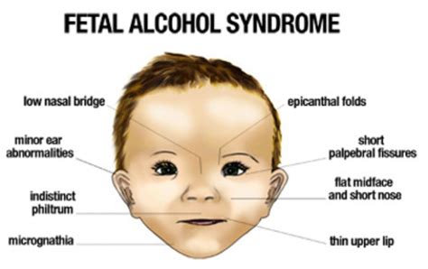 Ice Spice Fetal Alcohol Syndrome: A Comprehensive Guide