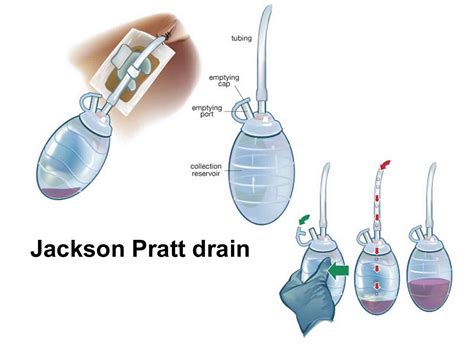 Jackson Pratt Drainage Chart