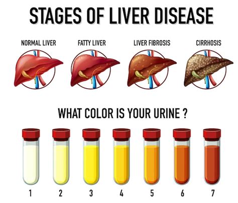 Liver Failure Urine Color Chart