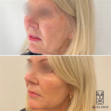 Mesoterapi före och efter: En transformerande behandling för din hud