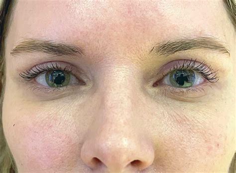När försvinner hängande ögonlock efter botox?