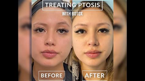 När släpper hängande ögonlock efter botox?