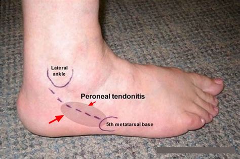 Navigating Weight-Bearing after Peroneal Tendon Surgery: An Essential Guide