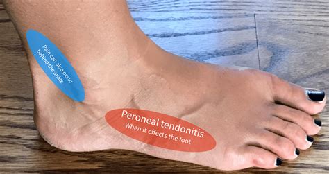 Peroneal Tendonitis Outer Side Foot Pain Chart