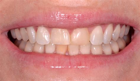 Saltblästring tänder - En revolutionerande ny tandblekningsmetod