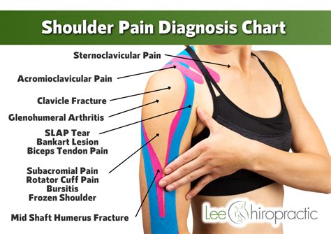 Shoulder Pain Chart