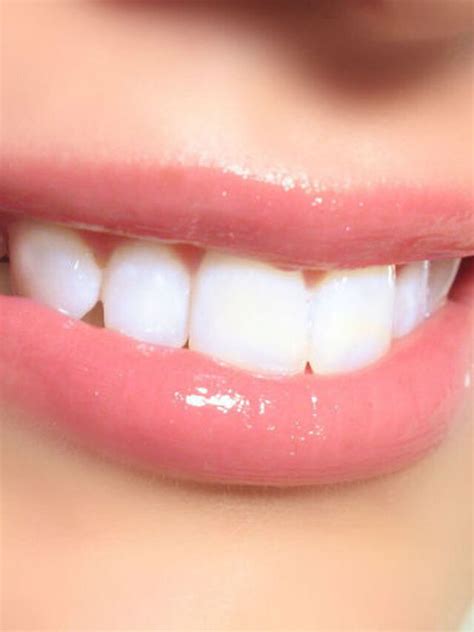Slipa Ner Tänder: Den Ultimata Guiden för ett Perfekt Leende