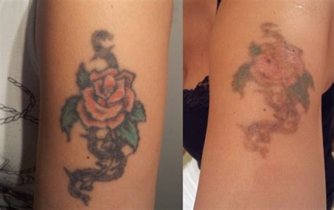 Ta bort tatueringar: Biverkningar och vad du kan förvänta dig