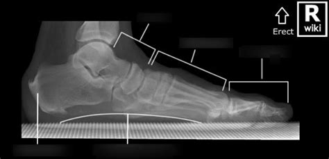 Unlock the Secrets of Weight Bearing Foot X-Ray Positioning for Exceptional Imaging
