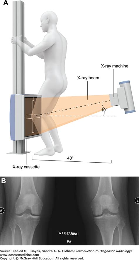 Unveiling the Secrets of Knee Weight Bearing X-Ray: A Comprehensive Guide