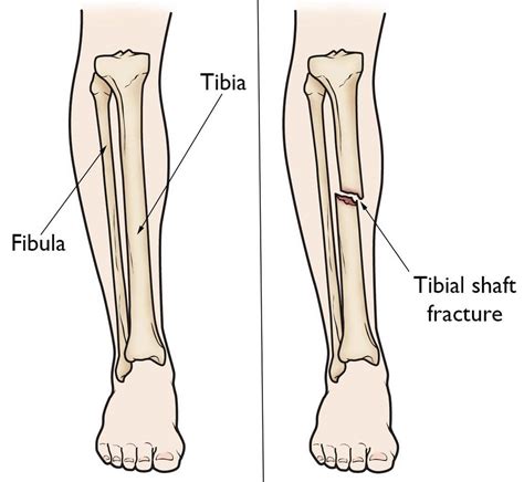 Weight Bearing After Distal Tibial Fracture: A Comprehensive Guide