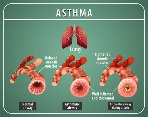 asthma diagram 