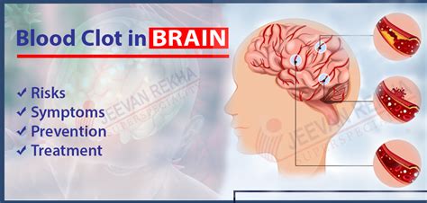 blood clot in brain