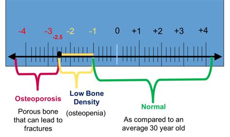 Bone Density Test Results Chart