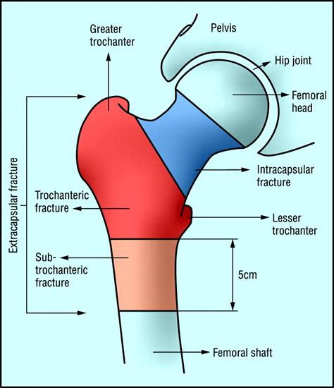 broken hip diagram 