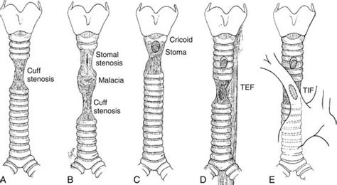 broken trachea