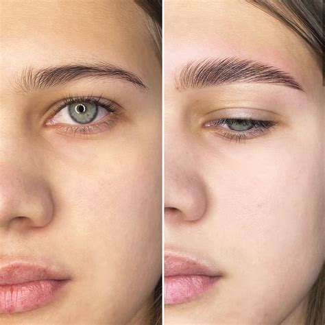 brow lift före efter